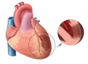 Arteriosclerosis Detector for Early Screening for Cardiovascular Disease